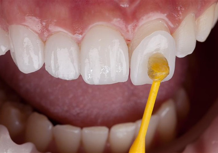 EMAX Veneers