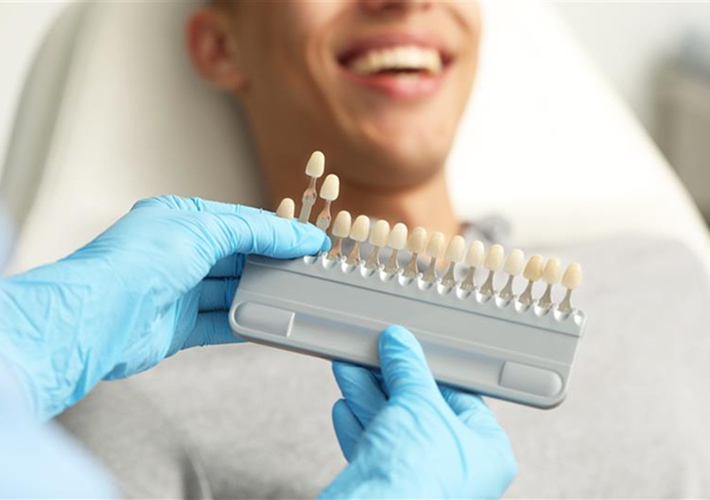 EMAX Veneers